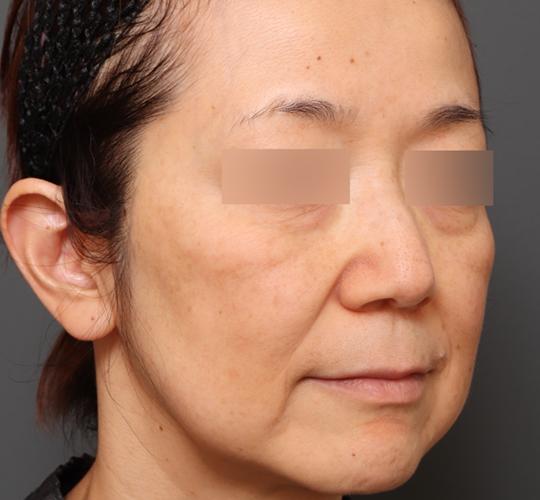 50代女性のヒアルロン酸注射  Before 症例写真