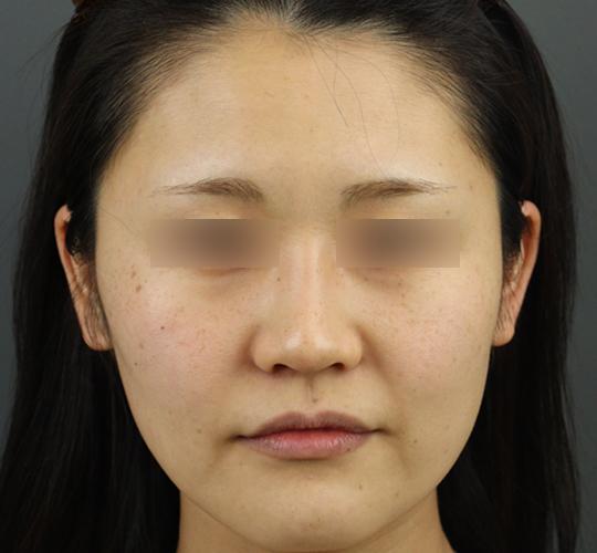 30代女性のシミ・そばかす Before 症例写真