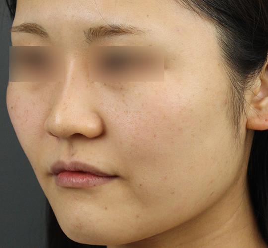 30代女性のクラリティフォトフェイシャルプラス Before 症例写真