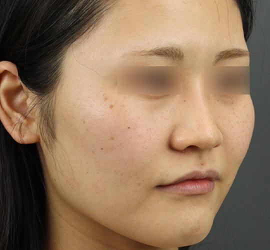 30代女性のクラリティフォトフェイシャルプラス Before 症例写真