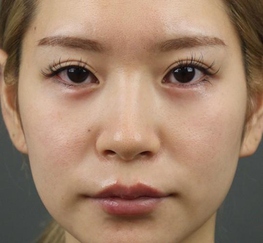 20代女性のヒアルロン酸注射（涙袋） After 症例写真