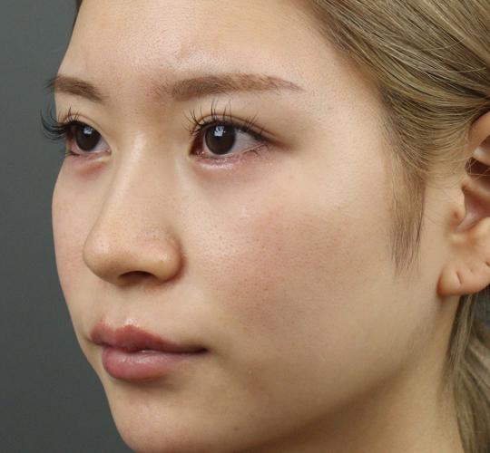 20代女性のヒアルロン酸注射（涙袋） After 症例写真