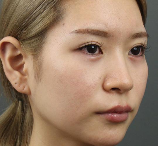 20代女性のヒアルロン酸注射（涙袋） After 症例写真