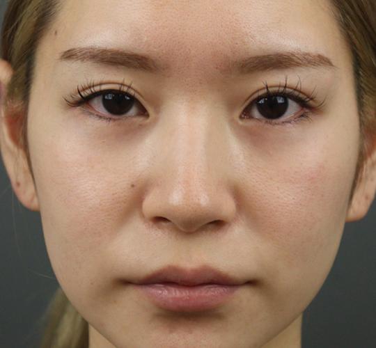 20代女性のヒアルロン酸注射（涙袋） Before 症例写真