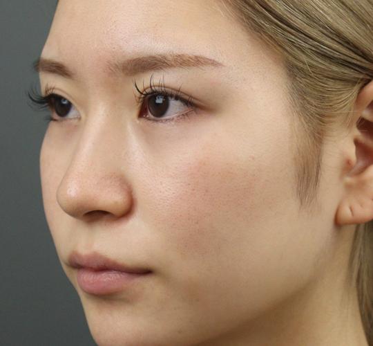 20代女性のヒアルロン酸注射（涙袋） Before 症例写真