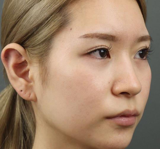 20代女性のヒアルロン酸注射（涙袋） Before 症例写真