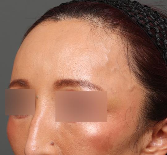 50代女性のヒアルロン酸注射  After 症例写真