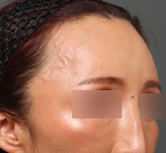 50代女性のヒアルロン酸注射  After 症例写真