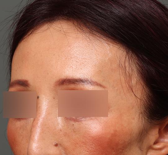 50代女性のヒアルロン酸注射  Before 症例写真