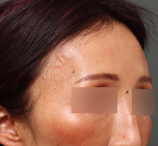 50代女性のヒアルロン酸注射  Before 症例写真