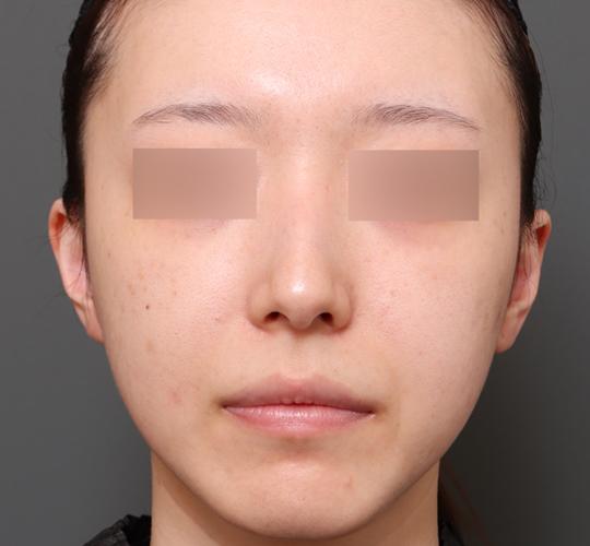 20代女性のシミ・そばかす After 症例写真