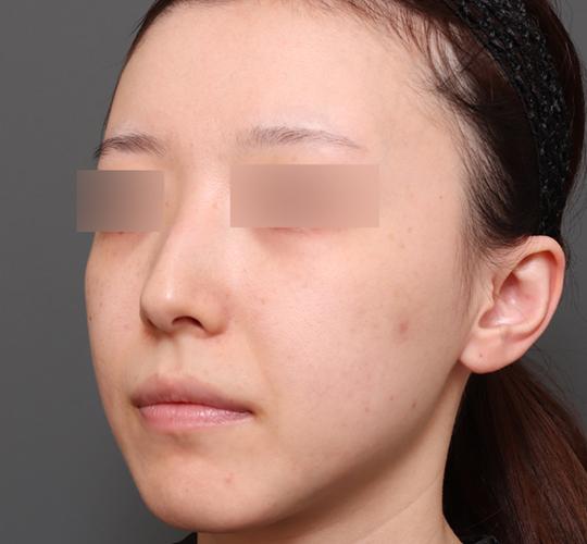 20代女性のクラリティフォトフェイシャルプラス After 症例写真