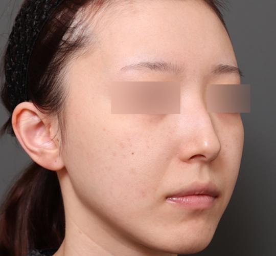 20代女性のクラリティフォトフェイシャルプラス After 症例写真