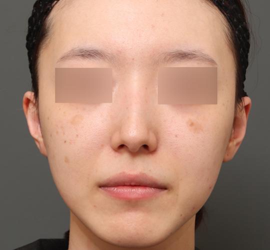 20代女性のシミ・そばかす Before 症例写真