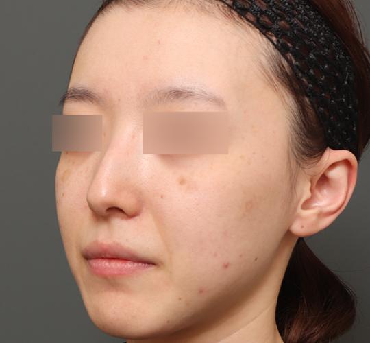 20代女性のクラリティフォトフェイシャルプラス Before 症例写真