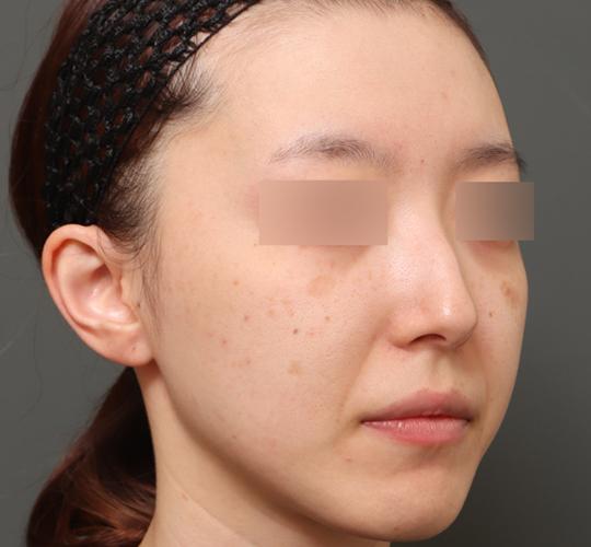 20代女性のクラリティフォトフェイシャルプラス Before 症例写真