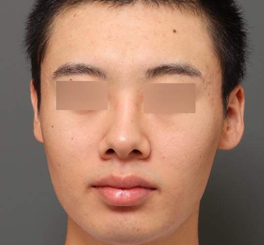 20代男性の毛穴・黒ずみ After 症例写真