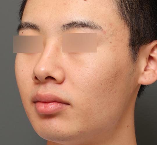 20代男性の肌管理毛穴スリークスキン(ダーマペン4) After 症例写真