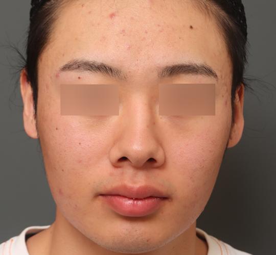 20代男性の毛穴・黒ずみ Before 症例写真