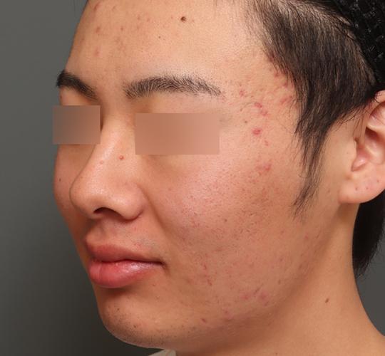 20代男性の肌管理毛穴スリークスキン(ダーマペン4) Before 症例写真