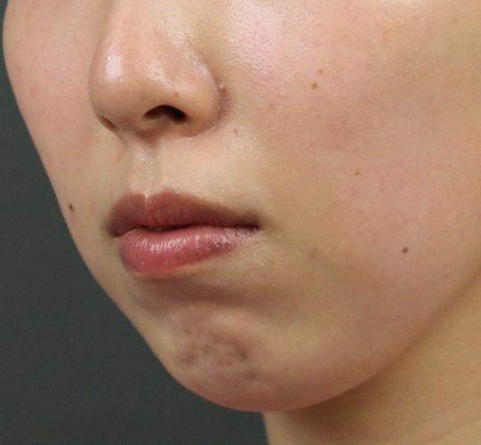 20代女性の人中短縮ボトックス After 症例写真