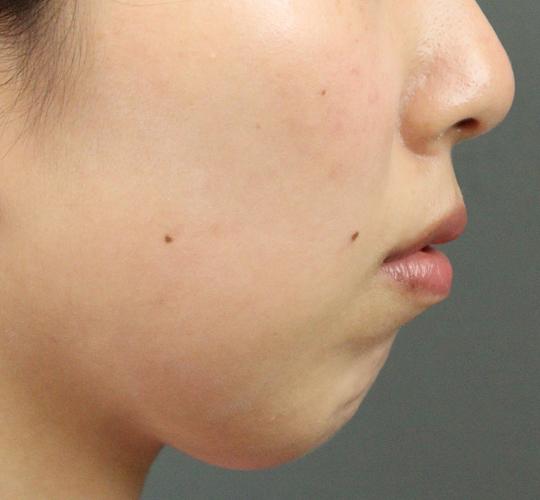 20代女性の人中短縮ボトックス After 症例写真