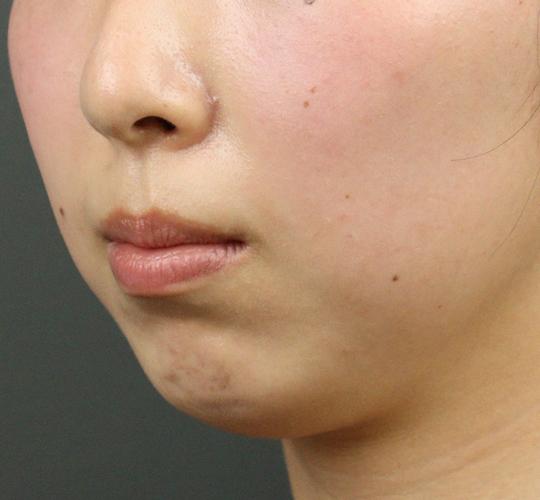 20代女性の人中短縮ボトックス Before 症例写真