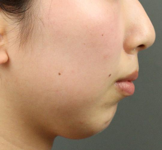 20代女性の人中短縮ボトックス Before 症例写真