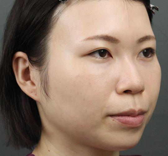 20代女性のヒアルロン酸注射（目の下） After 症例写真