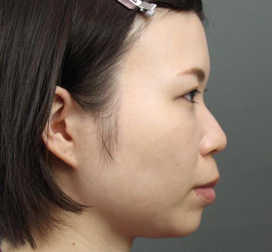 20代女性のヒアルロン酸注射（目の下） After 症例写真