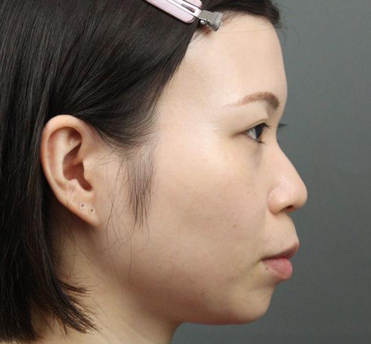 20代女性のヒアルロン酸注射（目の下） Before 症例写真