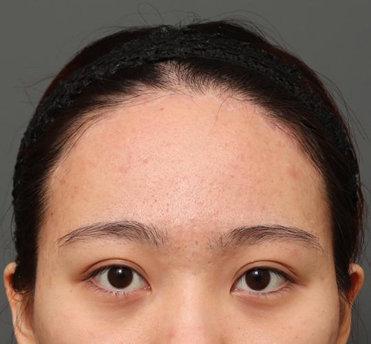 20代女性のエラ・アゴ・小顔 After 症例写真