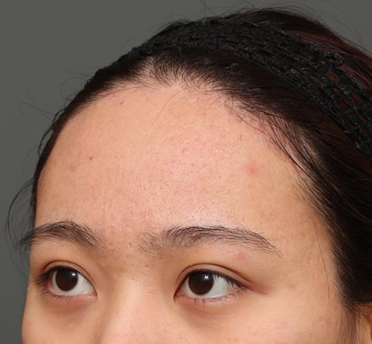 20代女性の額縮小 After 症例写真