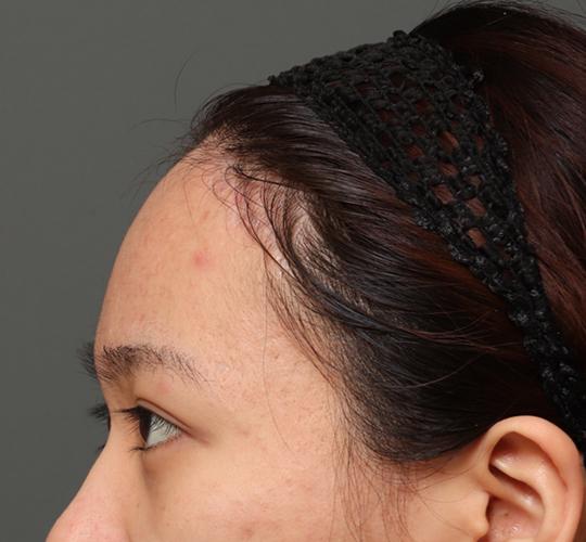 20代女性の額縮小 After 症例写真