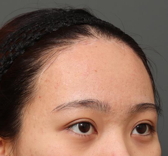 20代女性の額縮小 After 症例写真