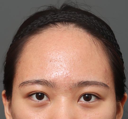 20代女性のエラ・アゴ・小顔 Before 症例写真