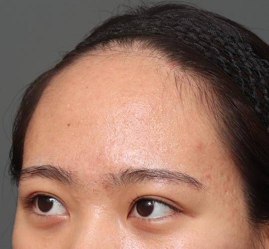 20代女性の額縮小 Before 症例写真