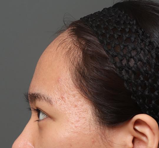 20代女性の額縮小 Before 症例写真