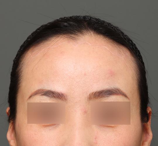 40代女性のエラ・アゴ・小顔 After 症例写真