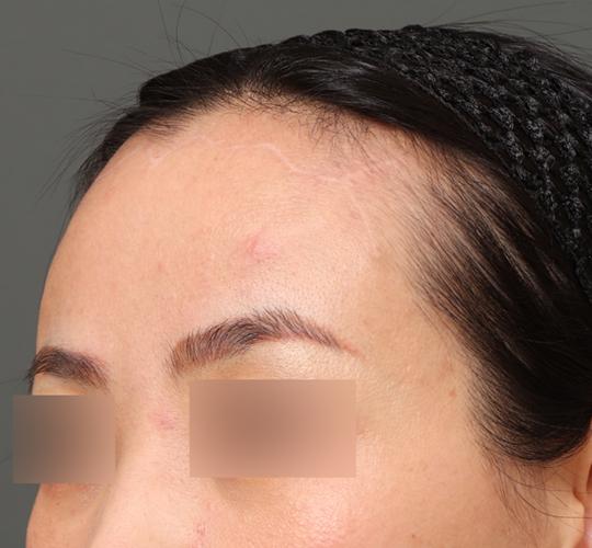 40代女性の額縮小 After 症例写真