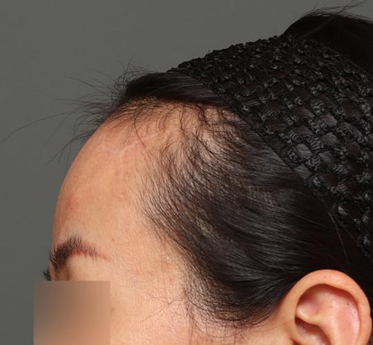 40代女性の額縮小 After 症例写真
