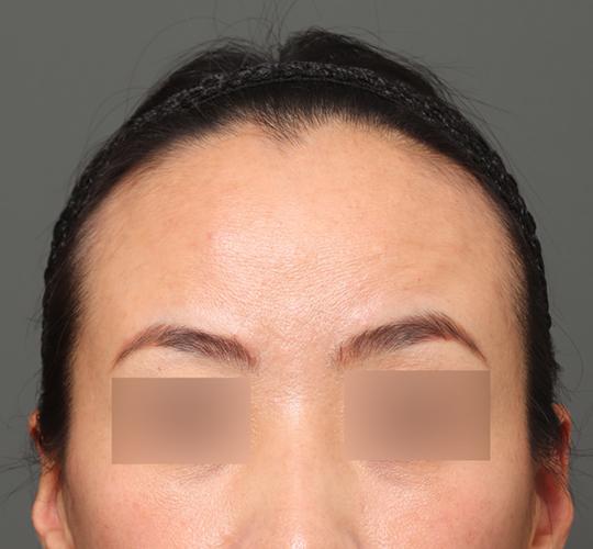 40代女性のエラ・アゴ・小顔 Before 症例写真