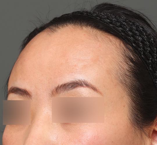 40代女性の額縮小 Before 症例写真