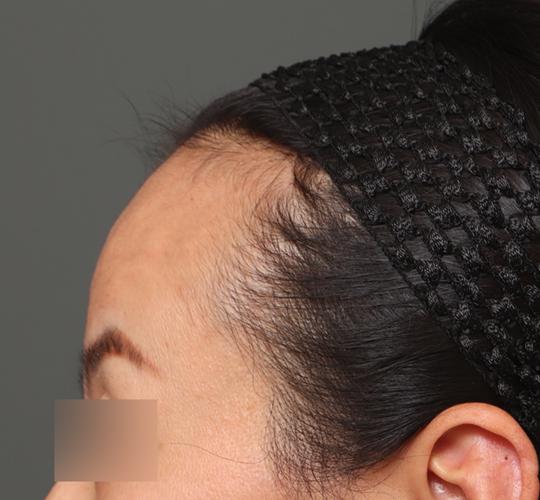 40代女性の額縮小 Before 症例写真