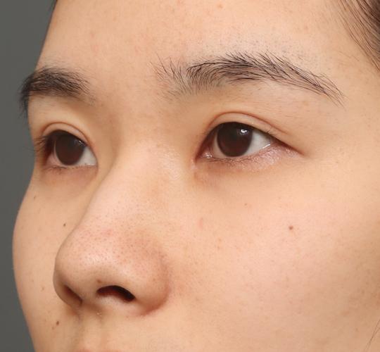 20代女性の全切開二重まぶた法 After 症例写真