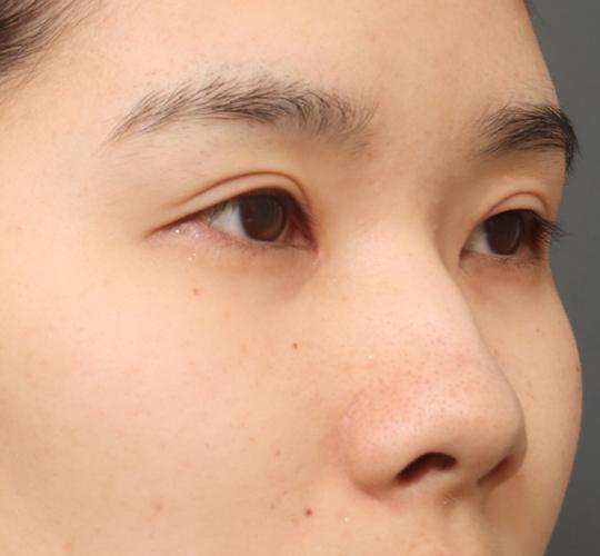 20代女性の全切開二重まぶた法 After 症例写真