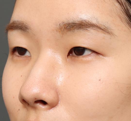 20代女性の全切開二重まぶた法 Before 症例写真