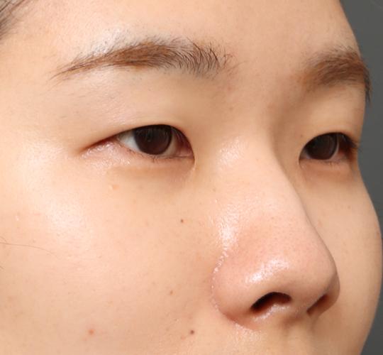 20代女性の全切開二重まぶた法 Before 症例写真