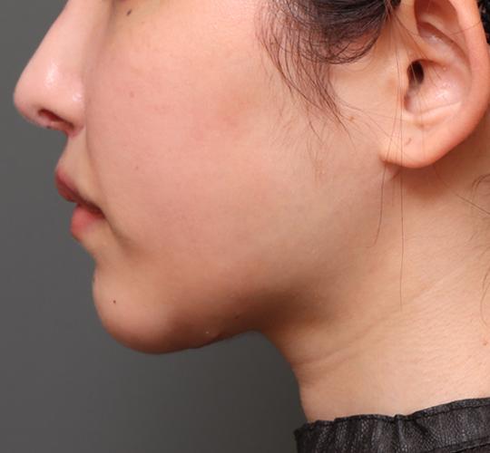 20代女性のエラ・アゴ・小顔 After 症例写真
