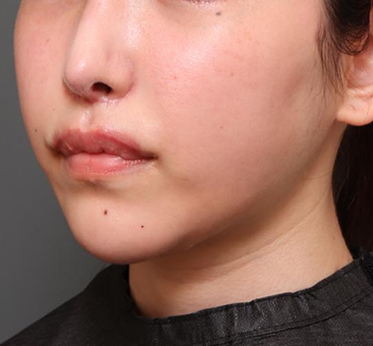 20代女性の二重アゴ筋肉縛り（ペリカン手術） After 症例写真